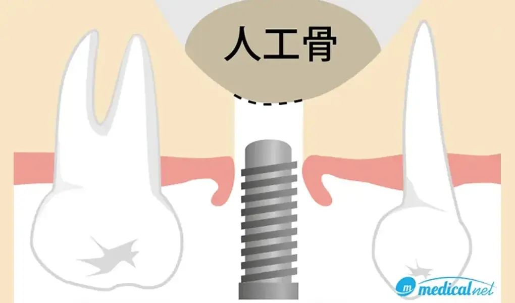 ソケットリフト（上顎洞底挙上術）