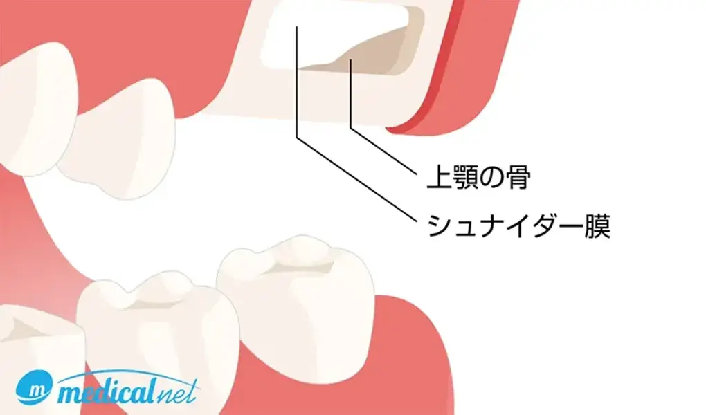 サイナスリフト（上顎洞底挙上術）