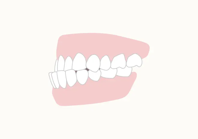 下顎前突（受け口・反対咬合）