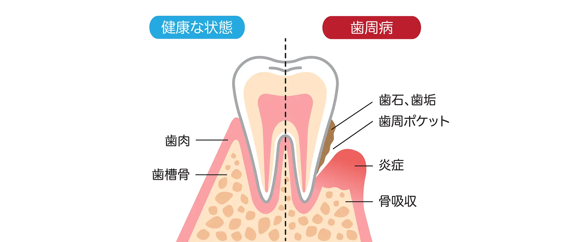 歯周病とは